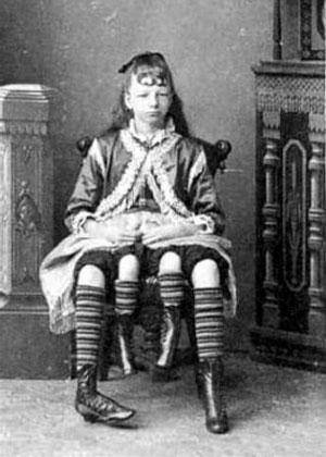 ერთადერთი ოთხფეხა გოგონა მსოფლიოში Myrtle Corbin, დაიბადა 1868 წელს ქალაქ კლებურნში