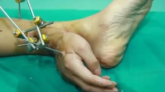 მოკვეთილი ხელი პაციენტს დროებით ფეხზე მიაკერეს