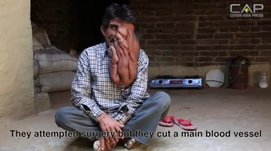 34 წლის ინდოელ მამაკაცს სპილოს დაავადება აქვს